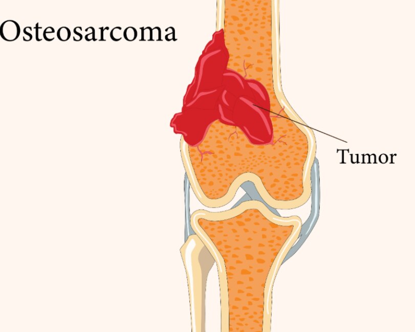 Osteosarcoma Symptoms Diagnosis and Treatment Options Explained