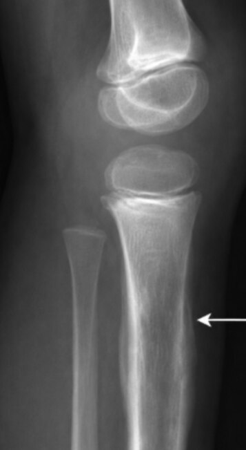 Ewings Sarcoma in Children and Young Adults What Families Should Know