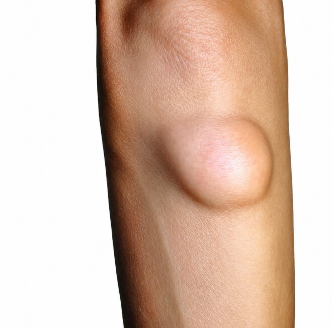 Soft Tissue Sarcoma Signs That May Require Specialist Evaluation
