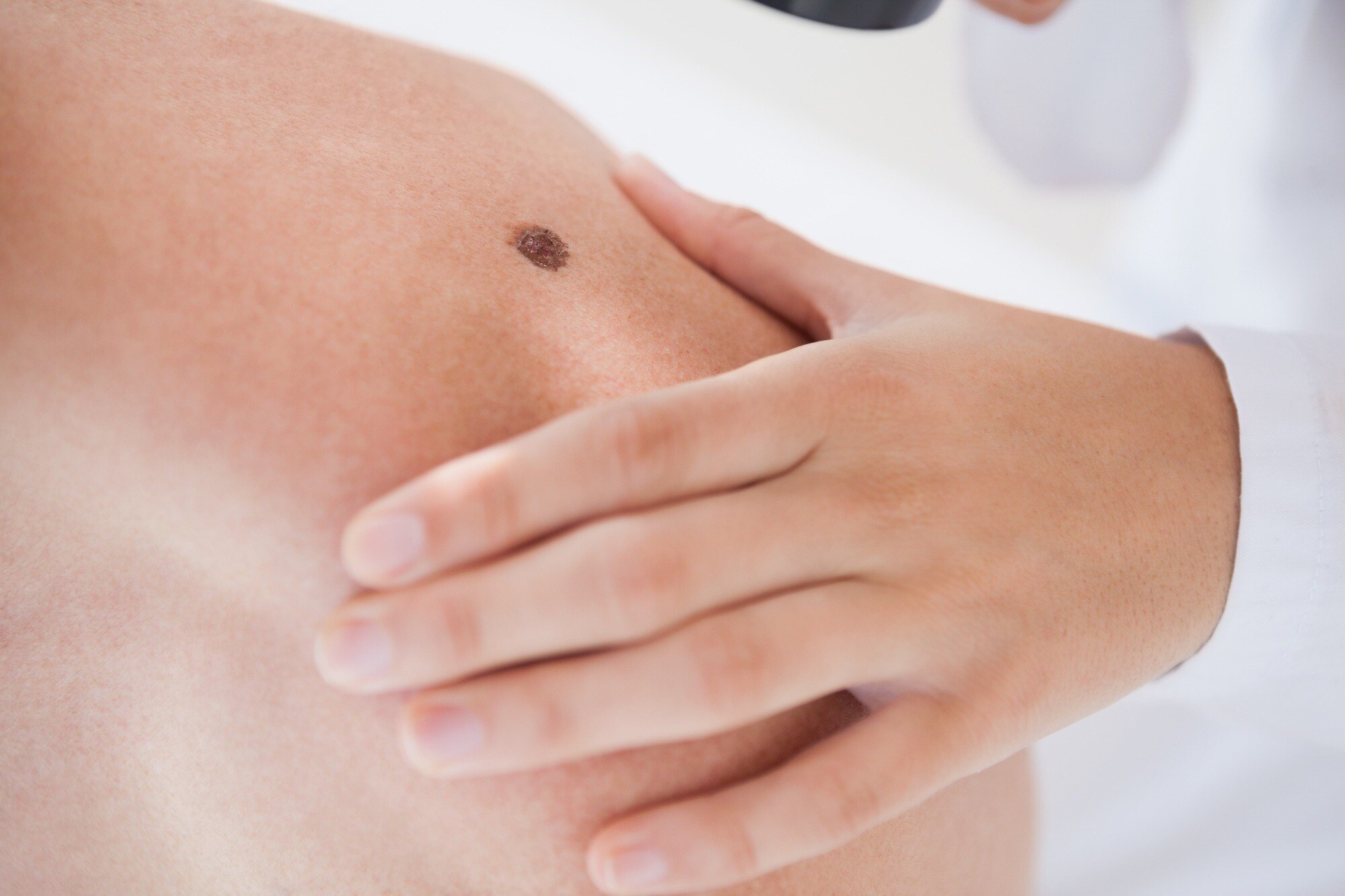 Melanoma Warning Signs and How Doctors Assess Suspicious Skin Changes