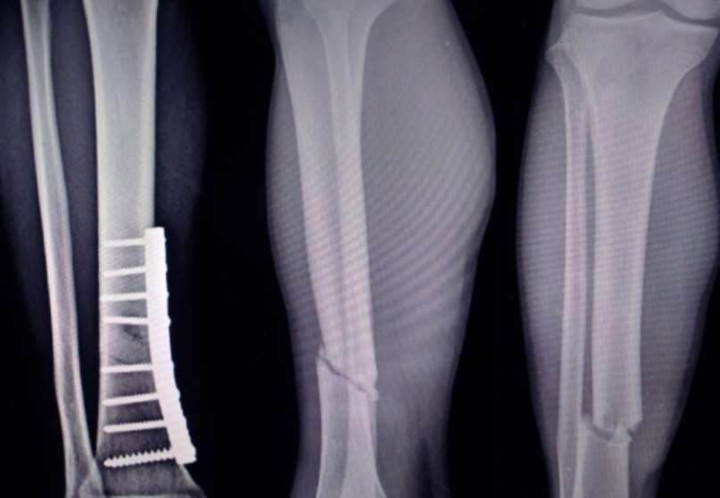 Megaprosthesis After Bone Tumor Surgery How It Helps Restore Limb Function