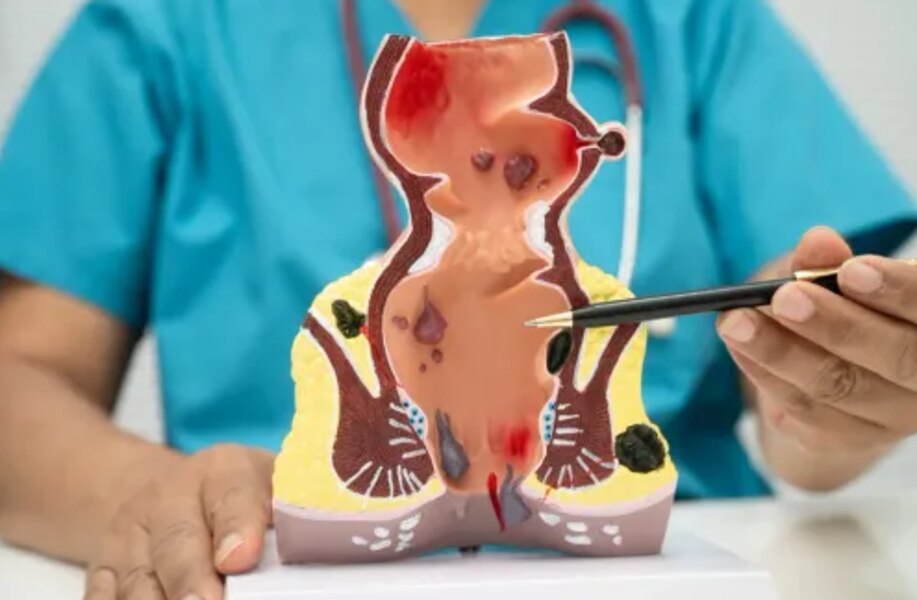 Piles Treatment Cost and Specialist Clinics in Dombivli