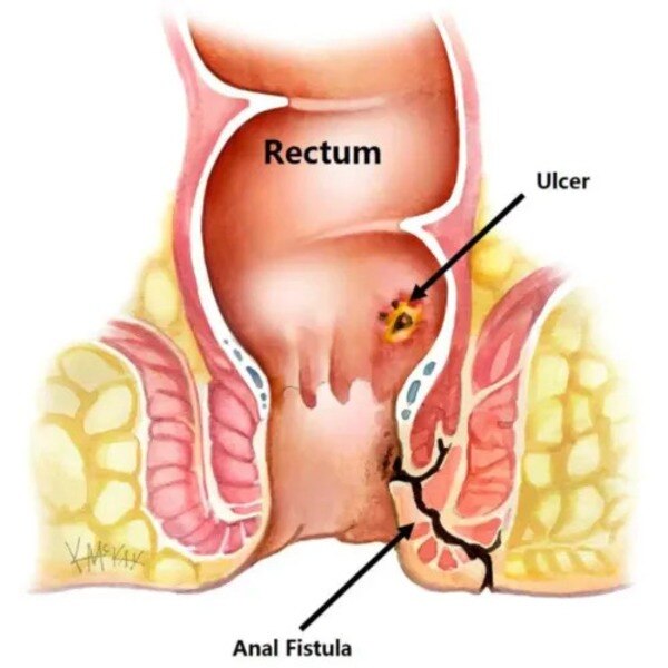 Fistula Treatment Cost and Clinics in Dombivli