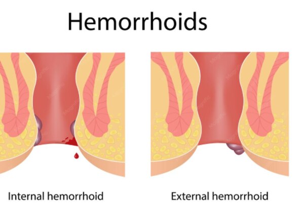 Are Hemorrhoid Treatments Suitable for Older Adults in Dombivli