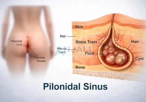 Is Pilonidal Sinus Treatment Worth It for Persistent Tailbone Discomfort