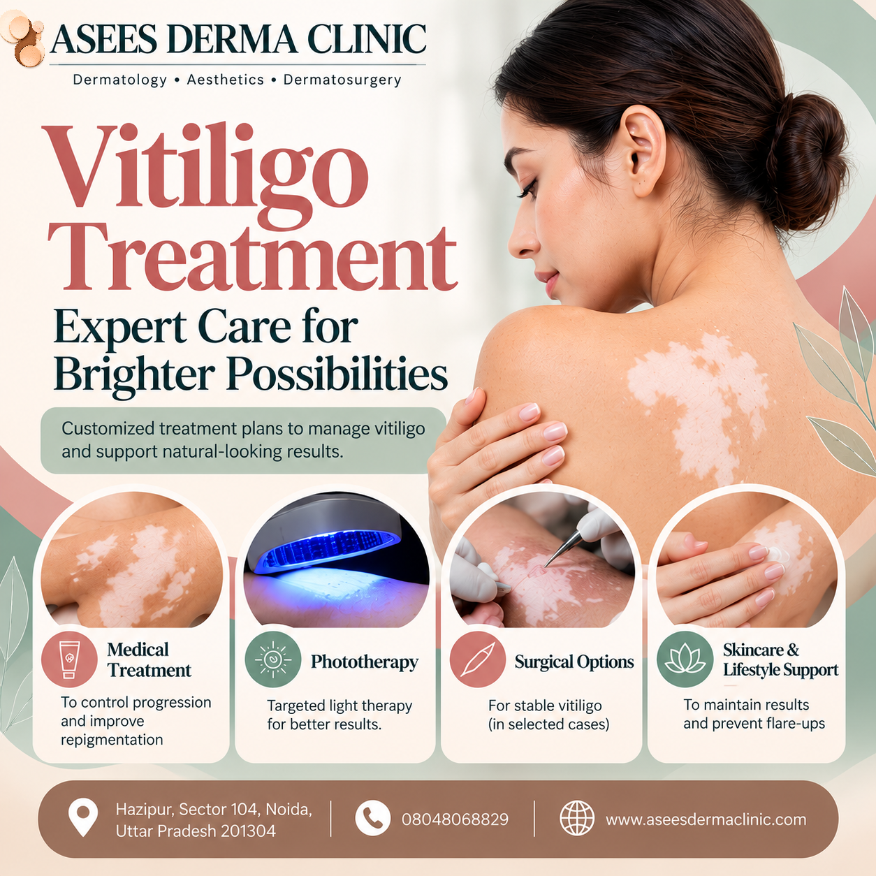 Vitiligo Treatment In Noida Sector 104