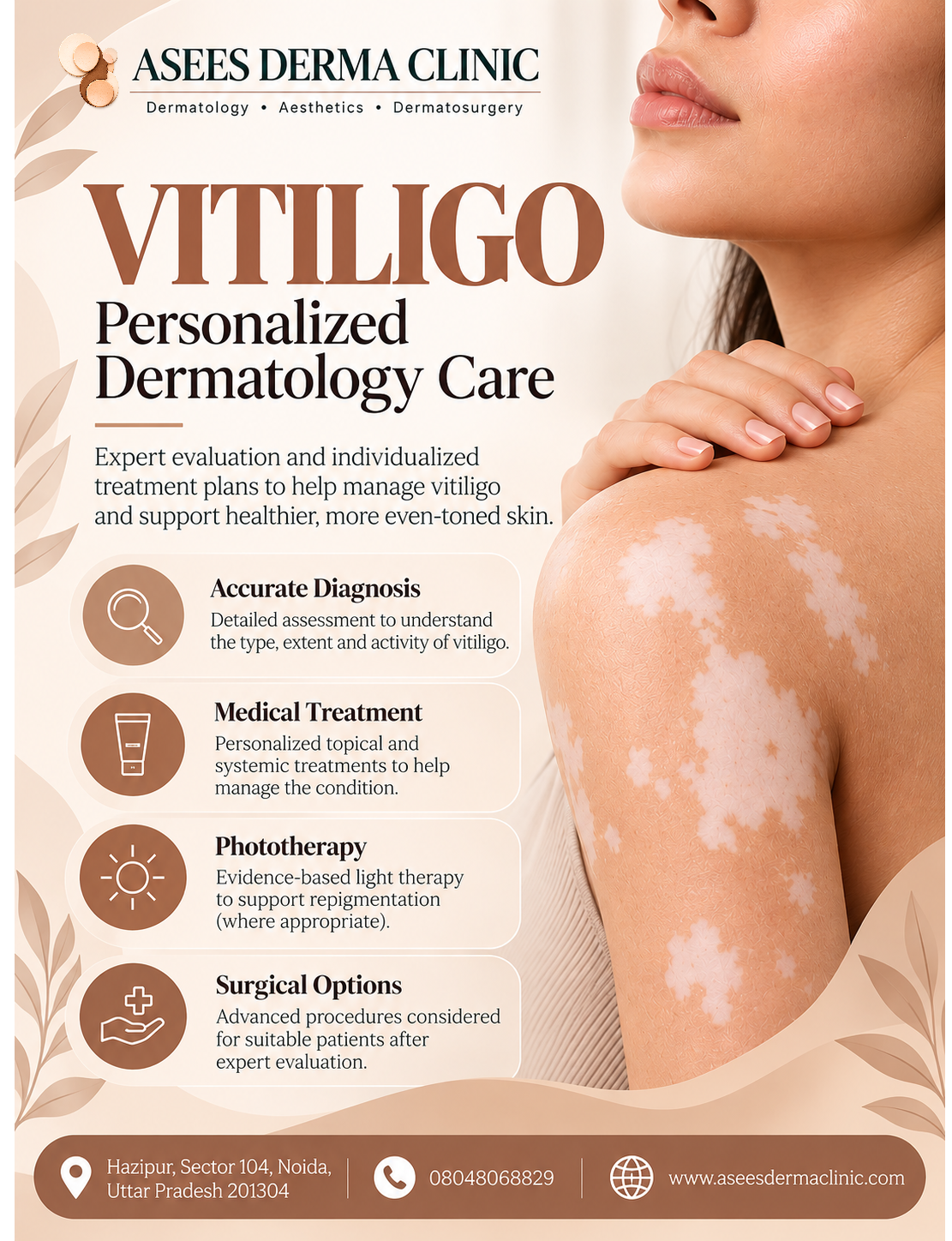 What is vitiligo?