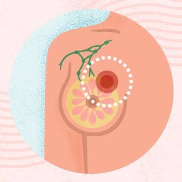 Breast Cancer – Symptoms, Diagnosis, Stages & Treatment