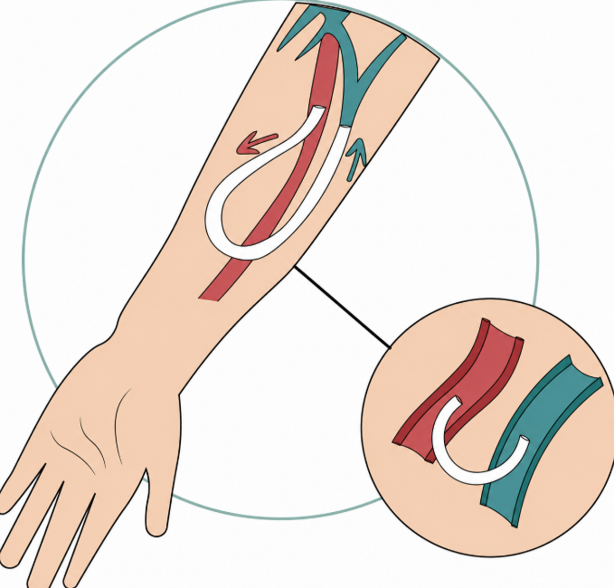 AV Fistula Care in Pokhran Road 2 Signs Your Dialysis Access Needs Medical Review