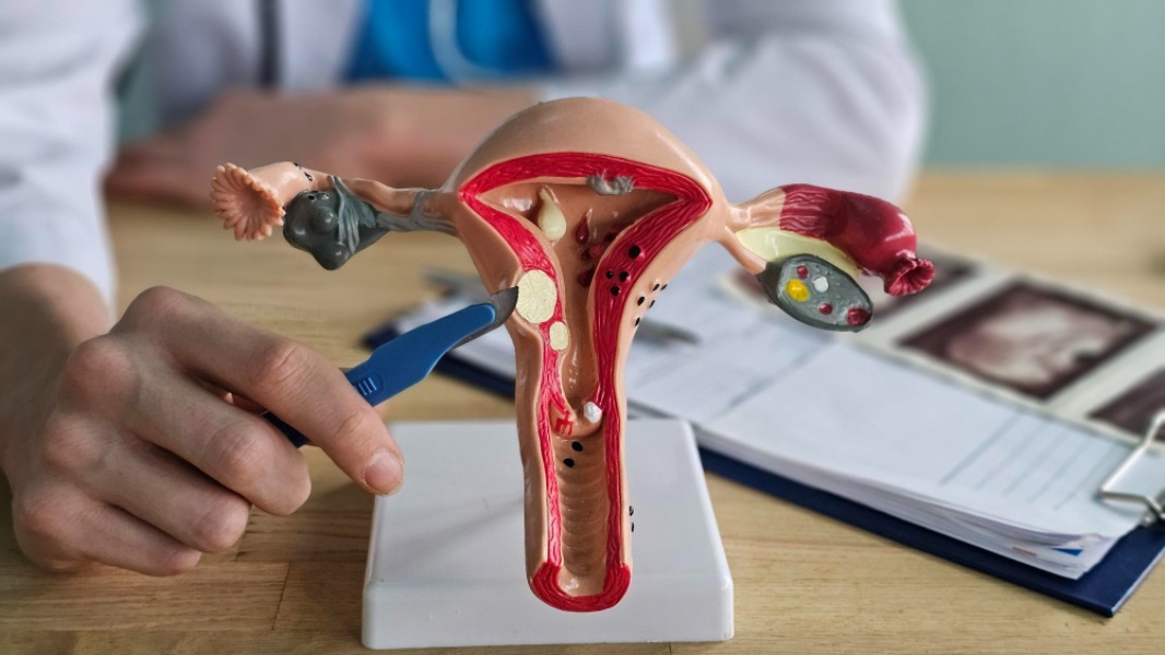 Myomectomy Treatment Doctors Help Evaluate Uterus Preserving Care