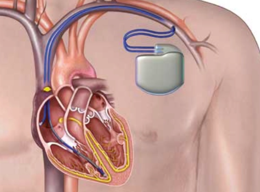 AICD and CRTD Devices How Their Roles Differ in Advanced Cardiac Care