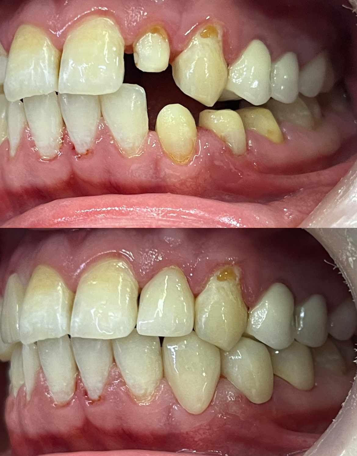 Rehabilitation focused on improving tooth form, alignment and most importantly function