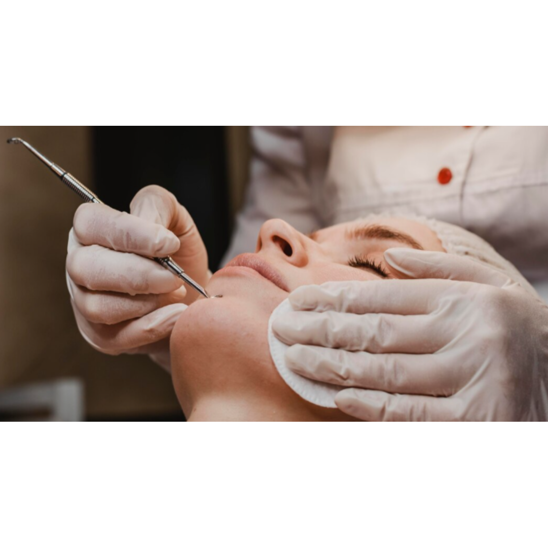 Acne Scars Treatment in Mahalunge: Why Different Scar Types Need Different Approaches