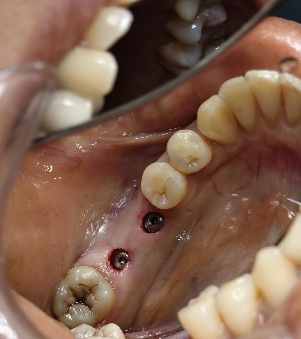 Dental Implant After Tooth Extraction: How Soon Can You Get One?