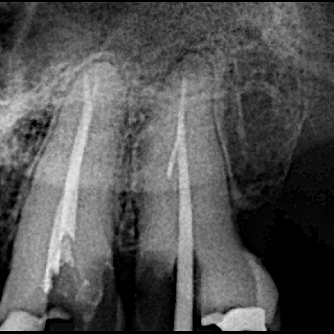 Broken Tooth: Can It Be Saved With a Crown or Does It Need Extraction?