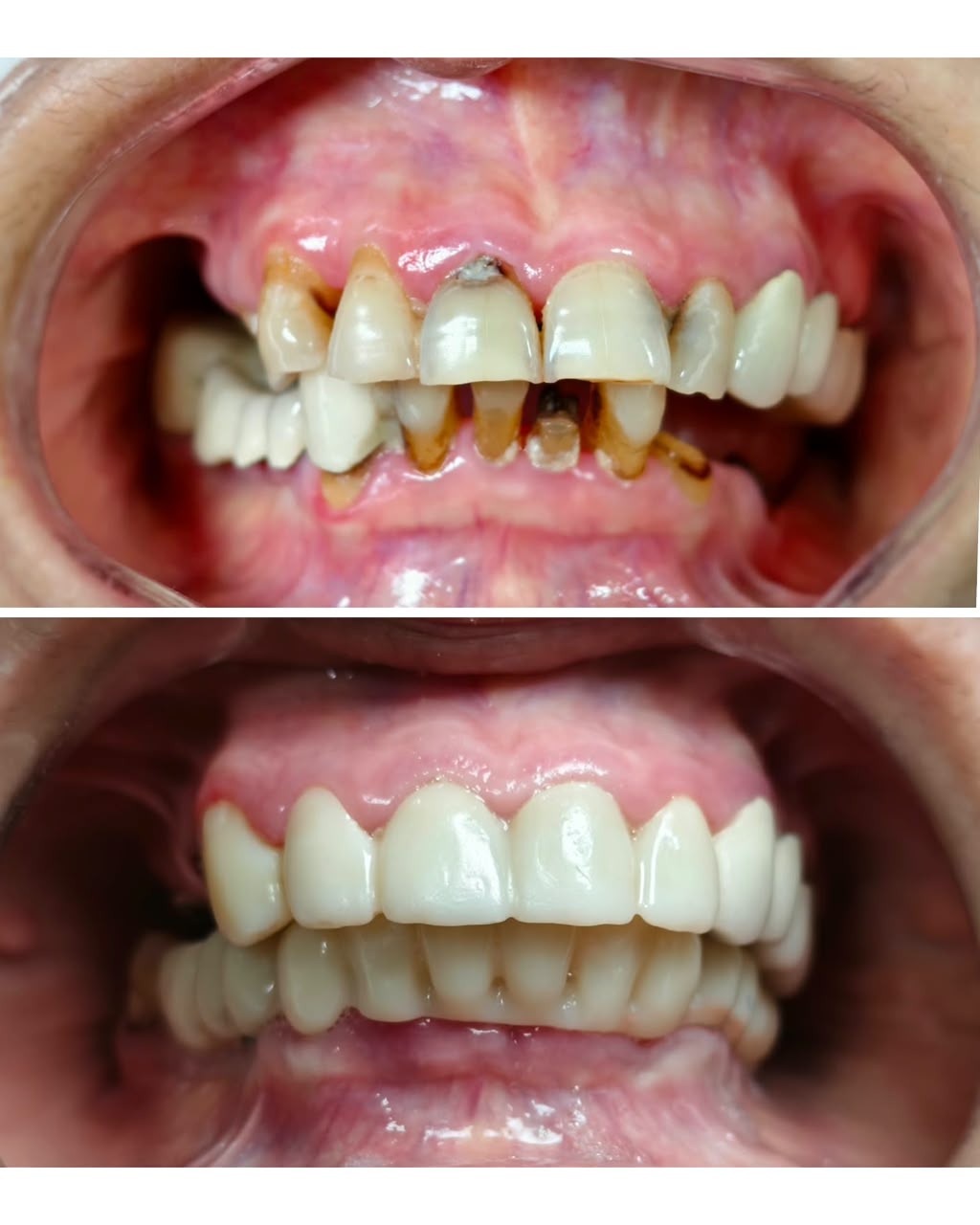 Loose Teeth in Adults: Can They Be Saved?