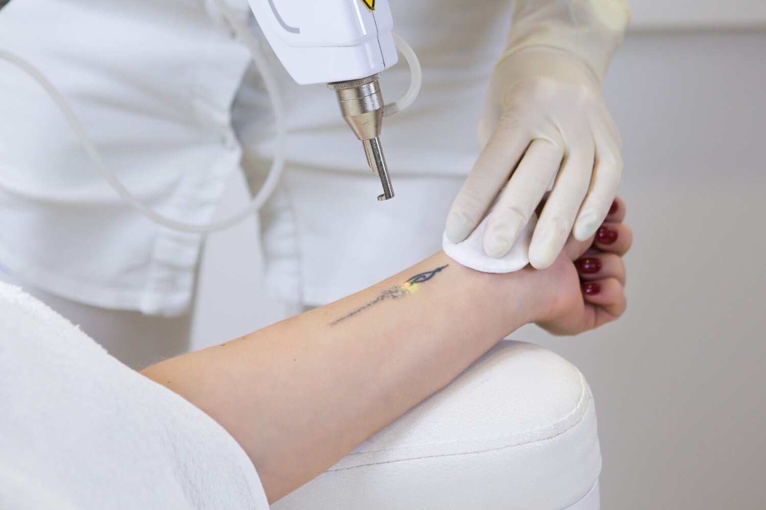 What to Know About Laser Tattoo Removal Before Starting Your Treatment Sessions