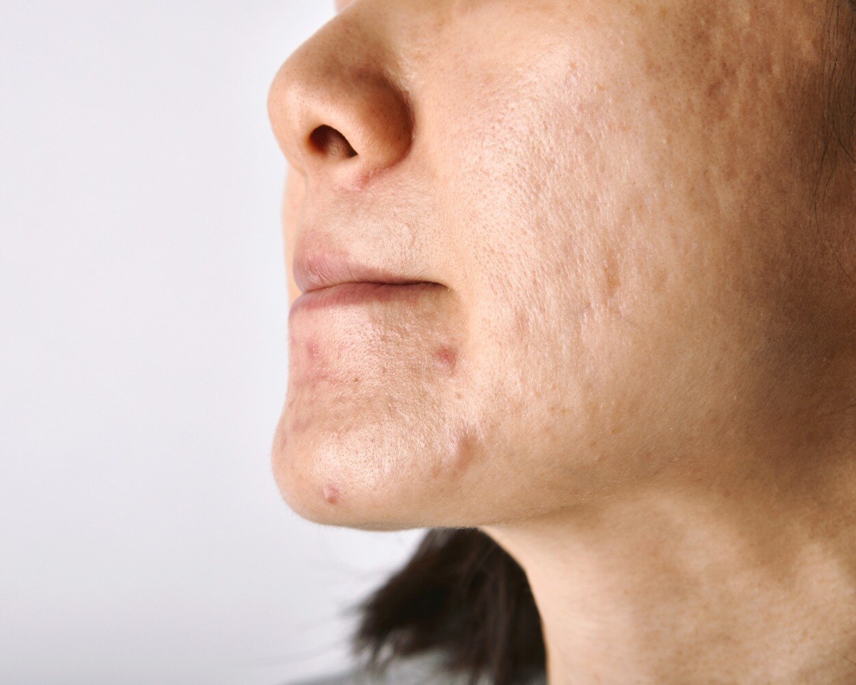 Acne Scar Treatment Options for Improving Post Acne Skin Texture