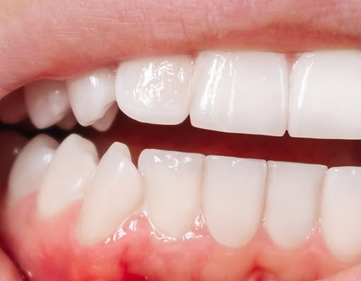 Diabetes and Oral Health