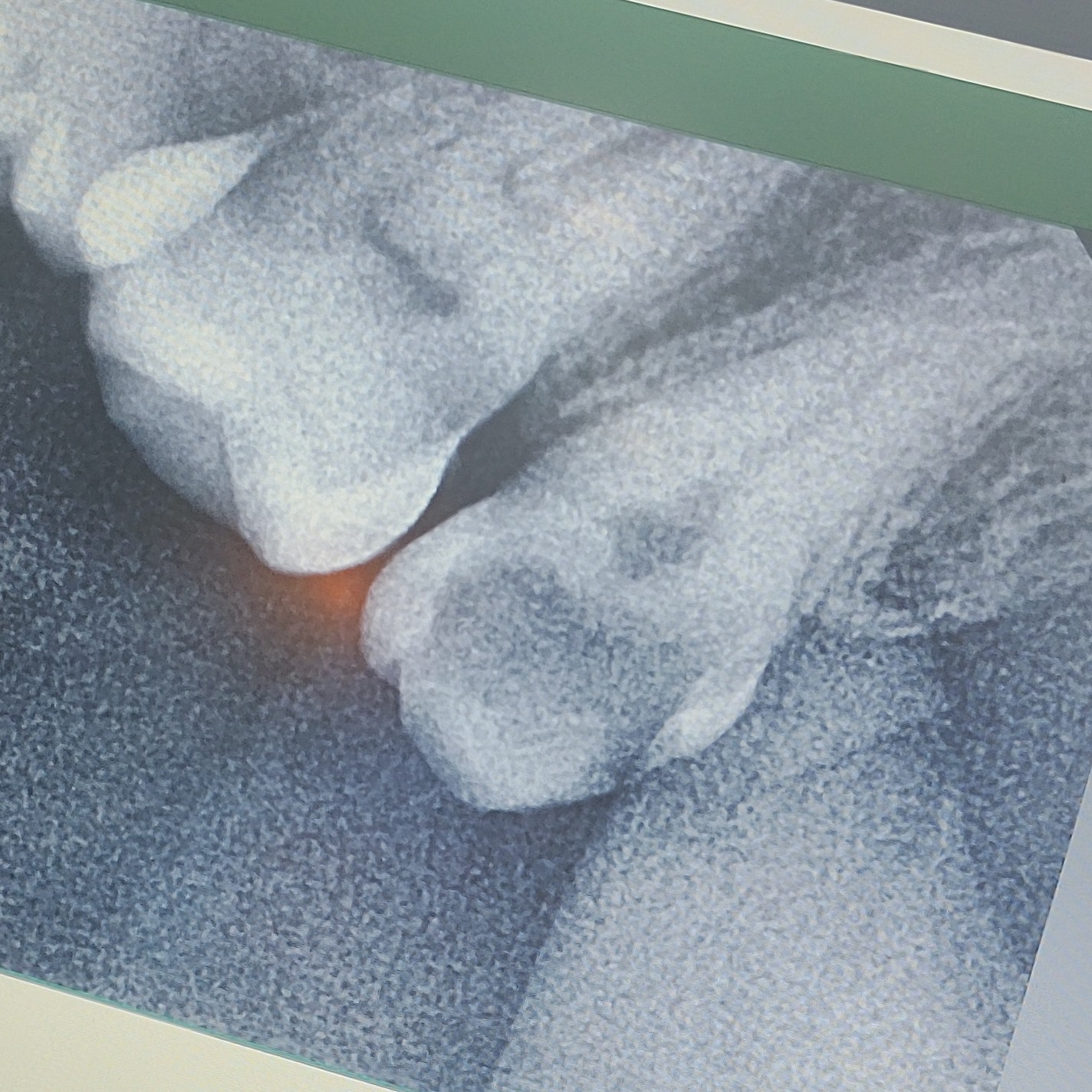 Why Does My Dentist Take X-Rays When Nothing Hurts?