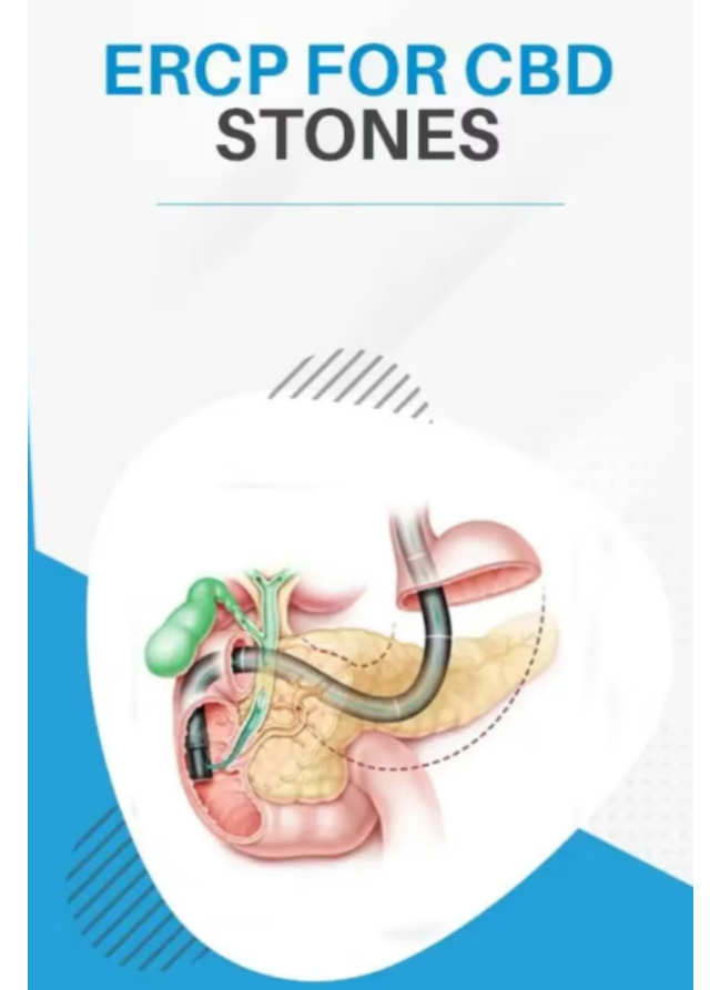 ERCP For CBD Stones in Karjat When Is This Procedure Considered