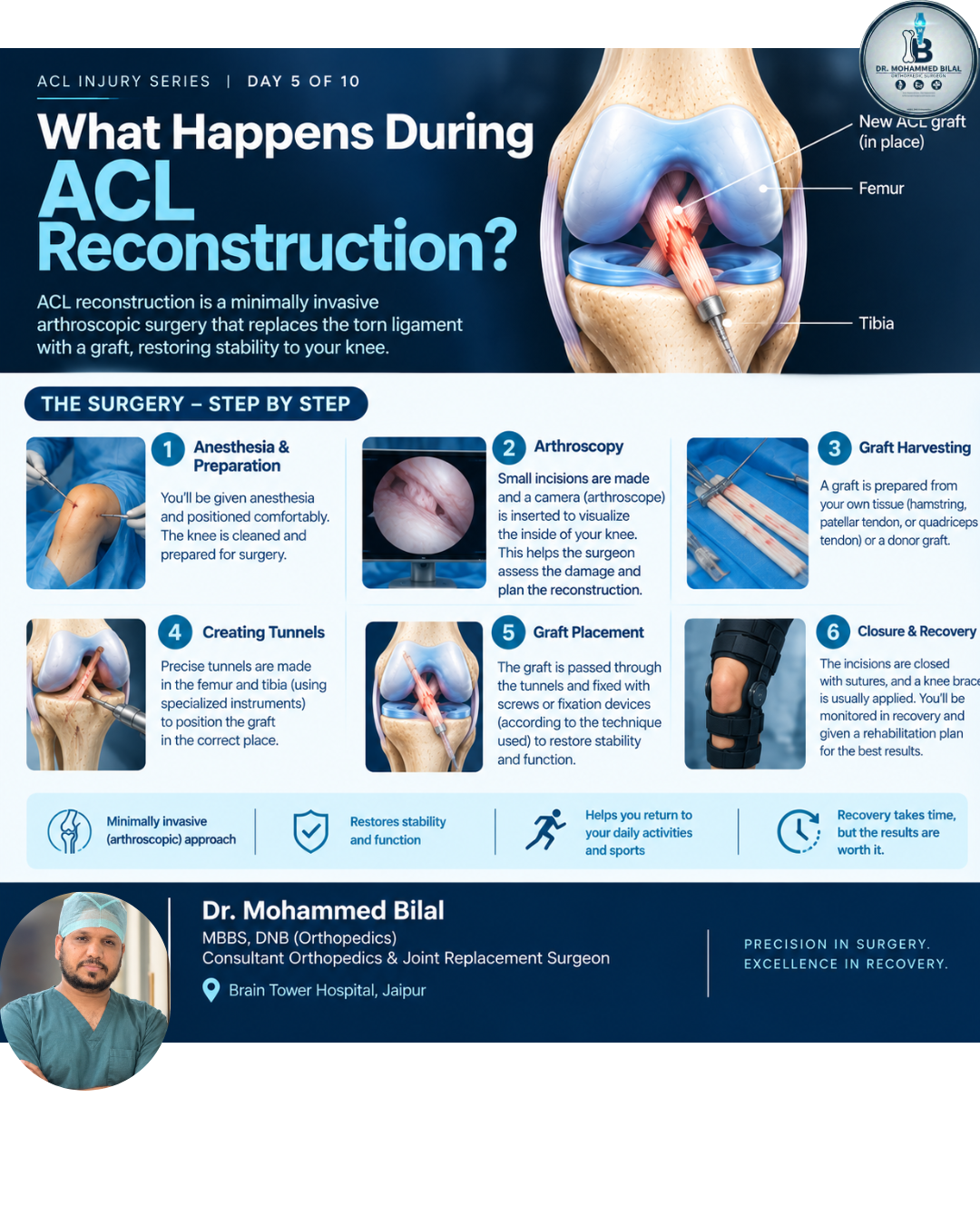 What Happens During ACL Reconstruction? Orthopedic, ACL, Surgery, Pain, Trauma, Jaipur, Dr. Bilal