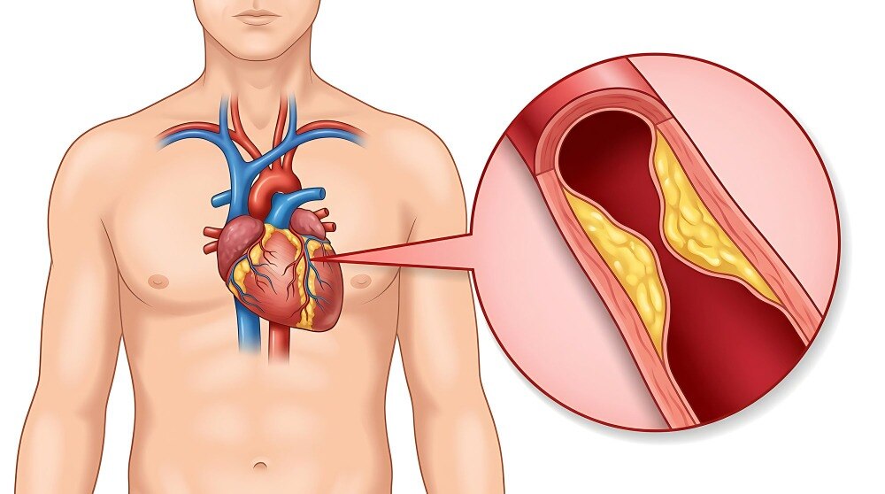 When Is Angiography Recommended for Checking Heart Blockages?