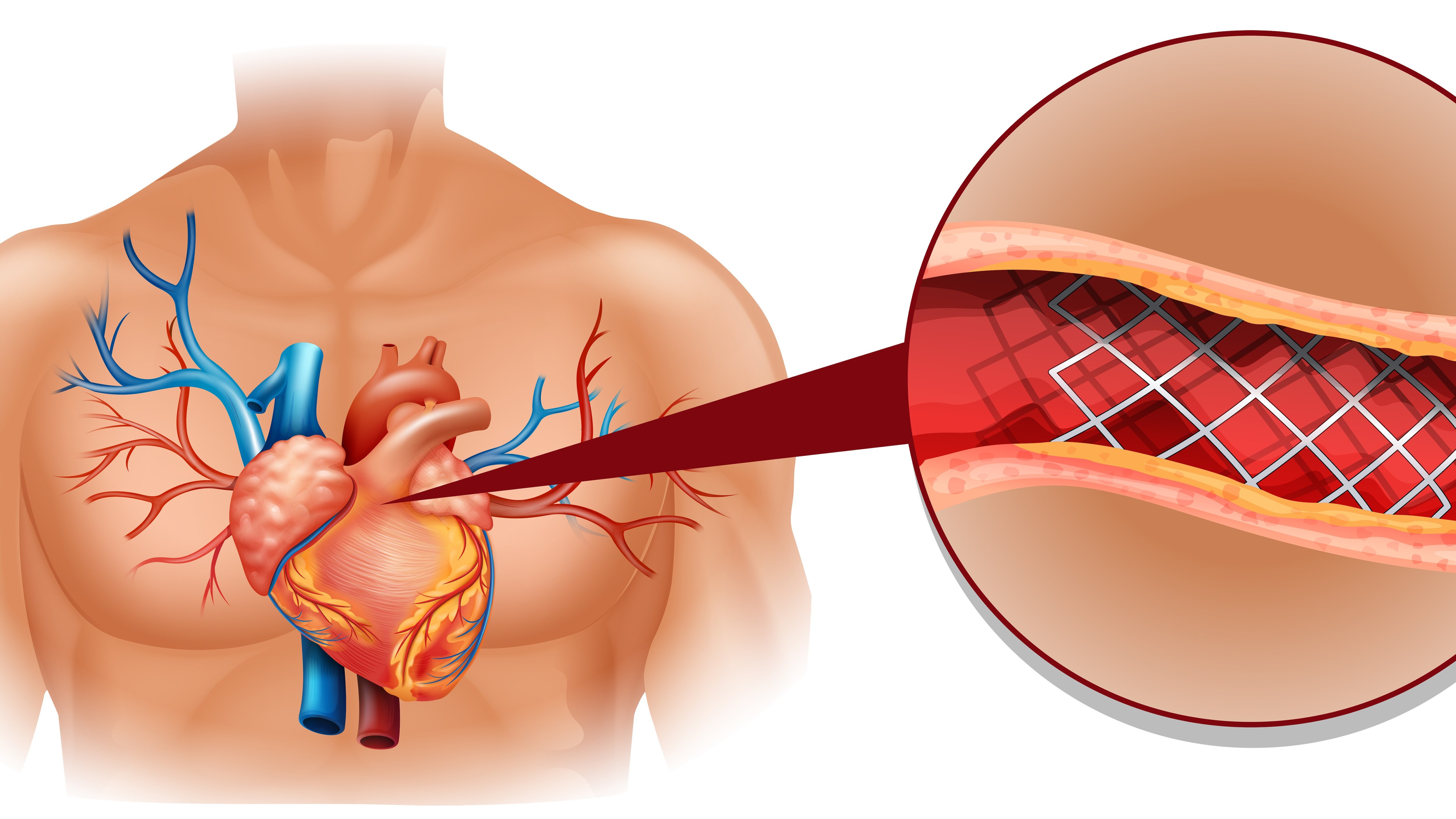 Angioplasty for Restoring Blood Flow in Blocked Heart Arteries
