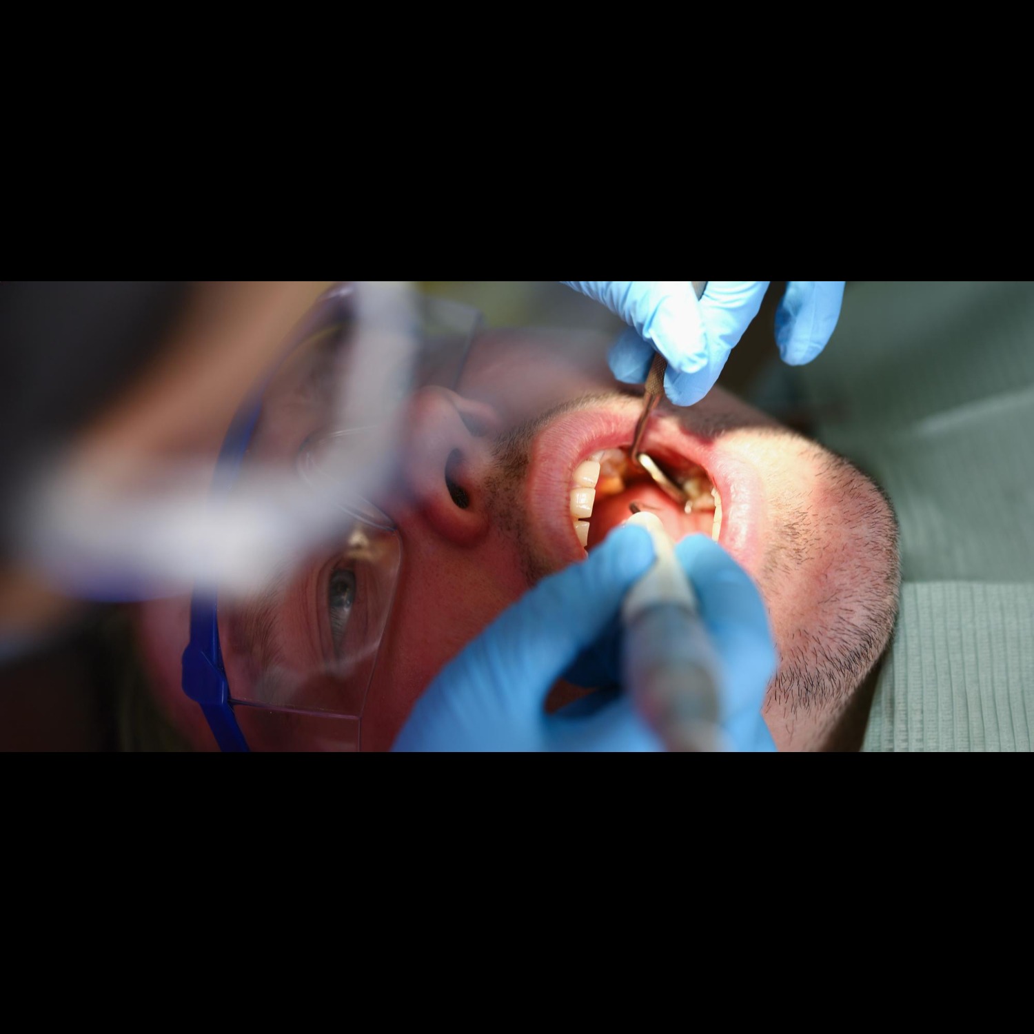 Zirconia Crown in Vikas Puri: When Is It Considered for a Damaged Tooth?