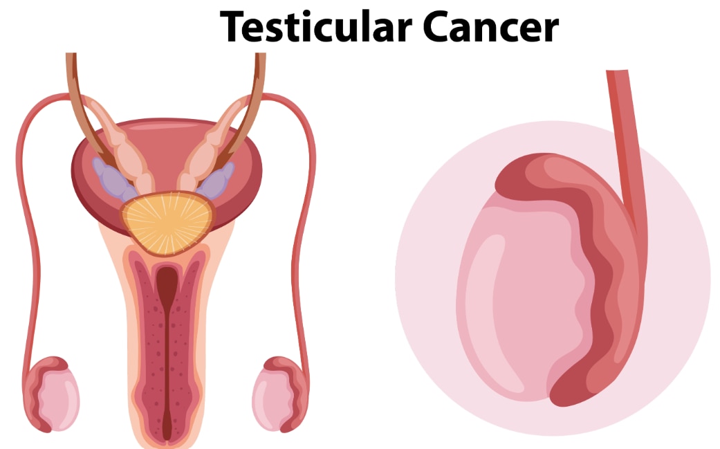 Testicular Cancer When Should a Testicular Lump or Swelling Be Checked