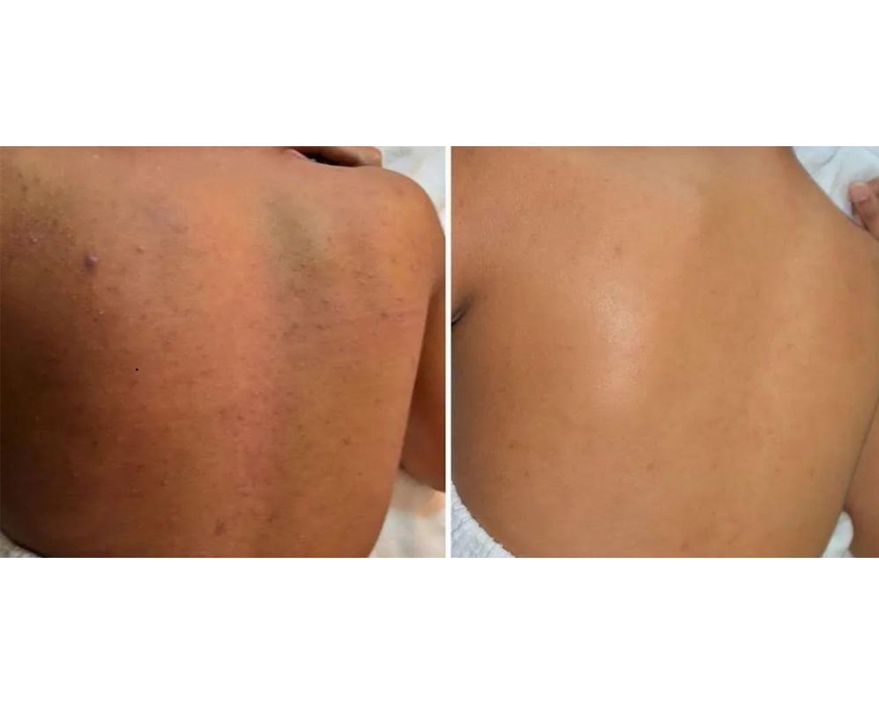 Chemical Peel in Wakad: Benefits, Suitability, Aftercare and Common Mistakes