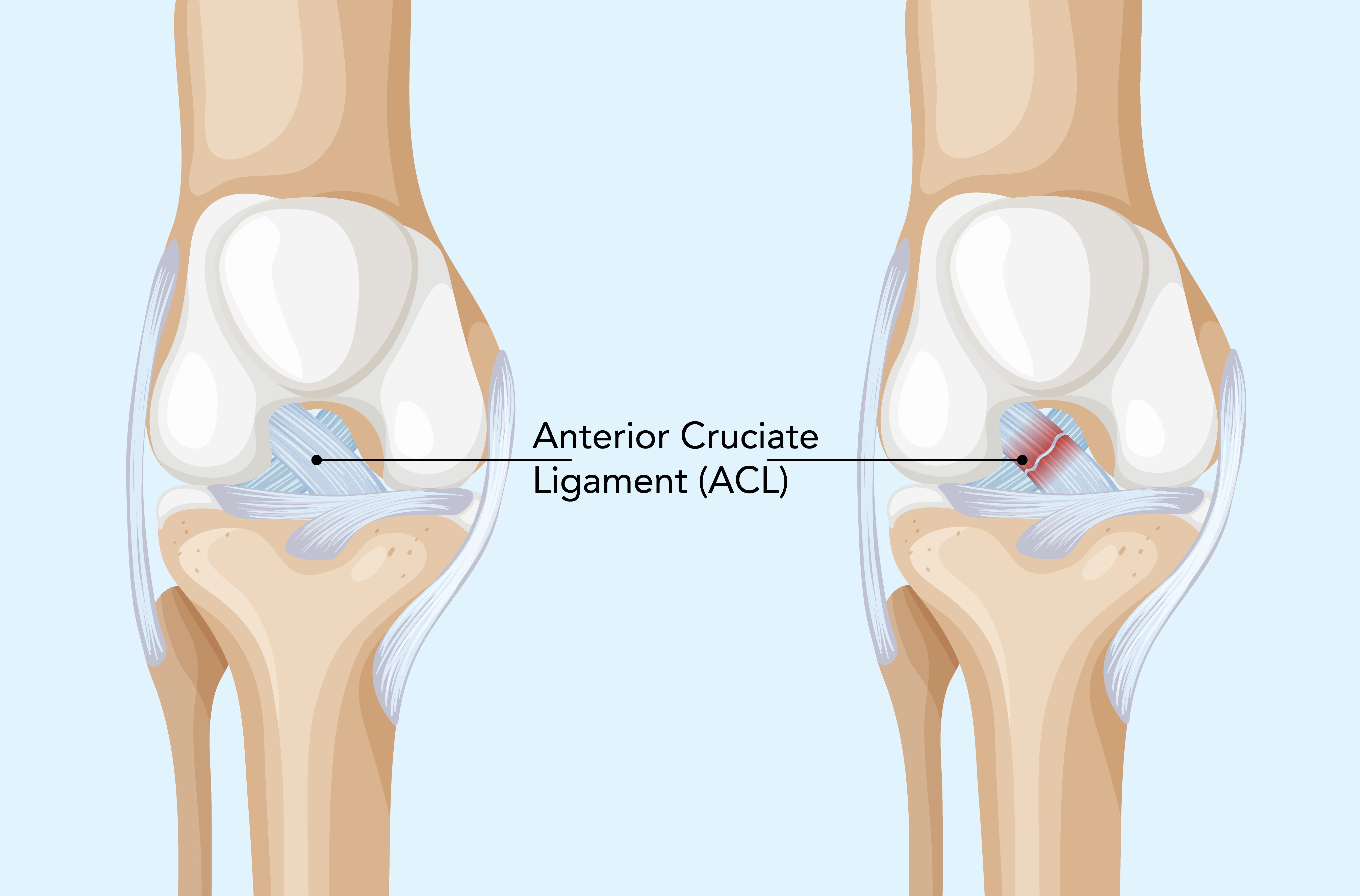 Managing Knee Instability With the Right ACL Injury Treatment