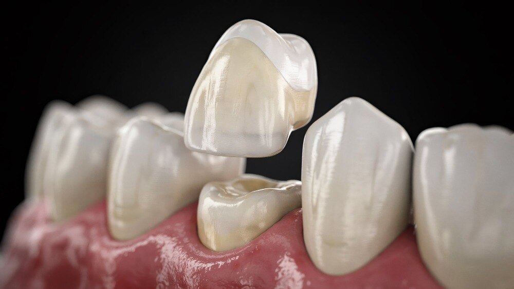 Are Crowns or Bridges Better for Damaged Teeth in Dombivli
