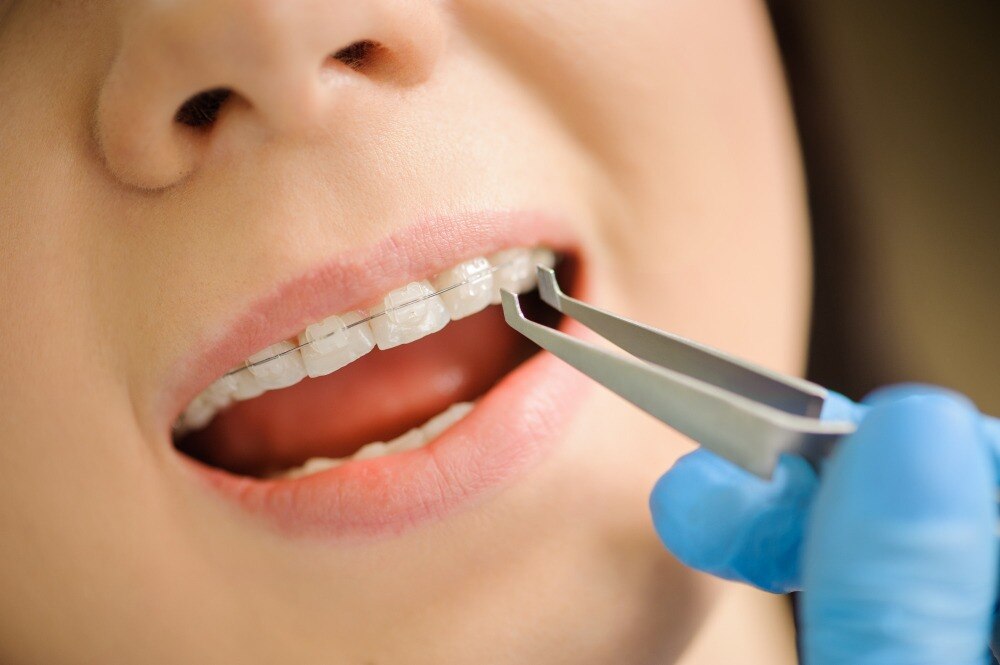 Are Ceramic Braces Worth It for Working Adults in Dombivli