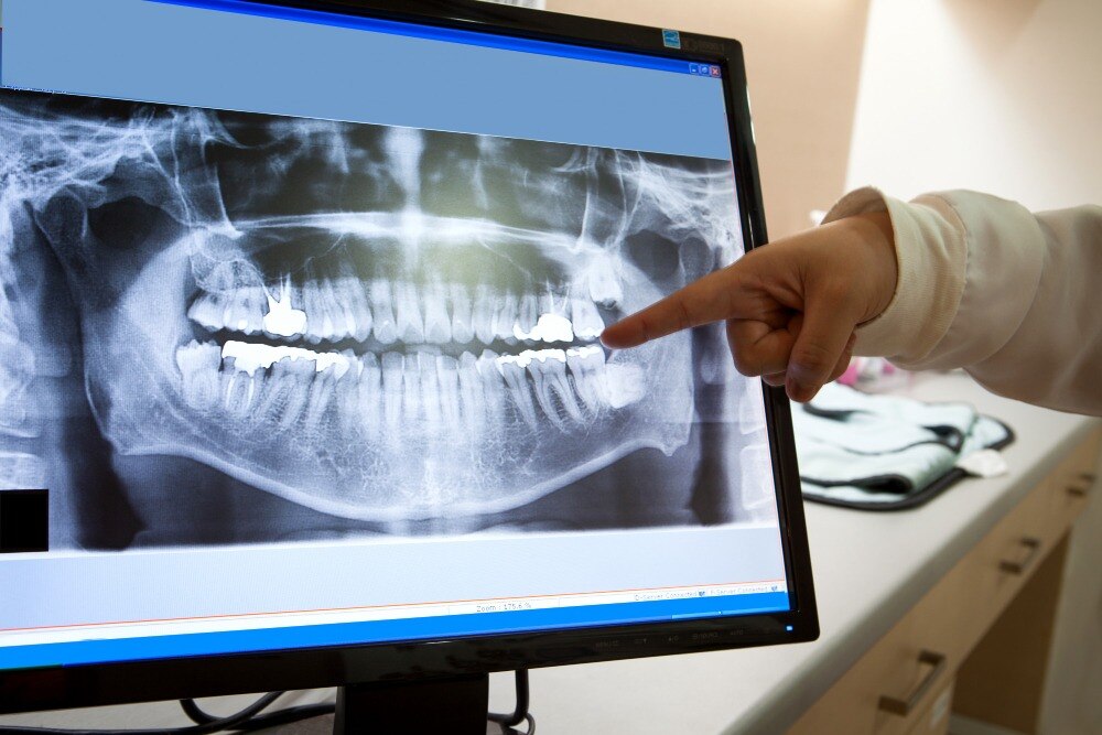 What Type of Dental X Ray Do You Need in Dombivli
