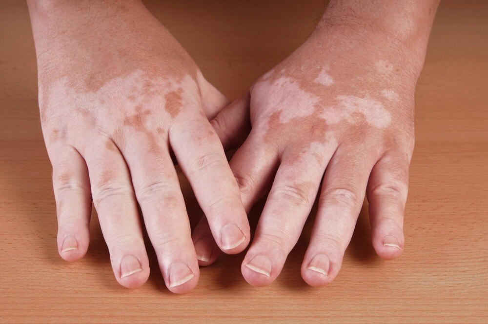 What Is Vitiligo Treatment Like from Consultation Through Follow Up