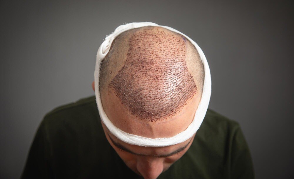 Hair Transplant for Receding Hairlines in Panvel