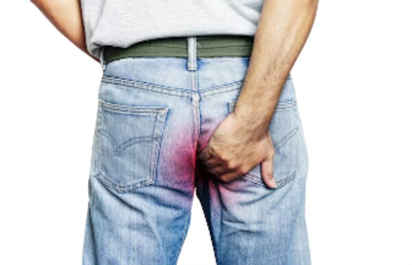 What Happens During Laser Pilonidal Sinus Surgery in Mumbai