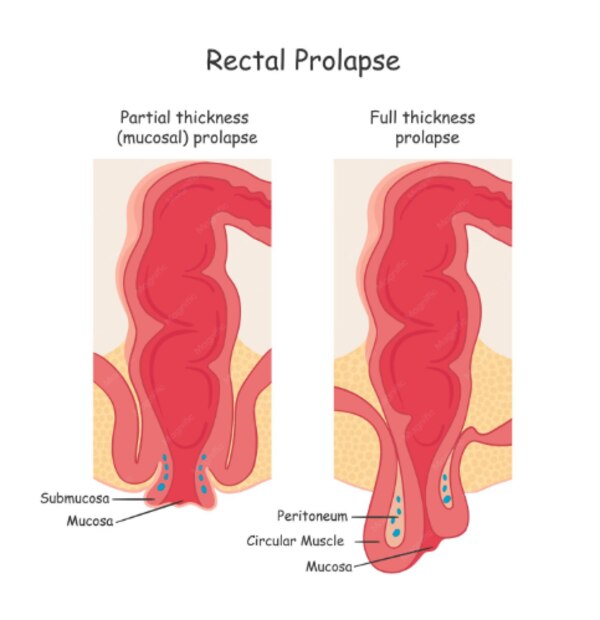 What Does Rectal Prolapse Surgery Include in Mumbai