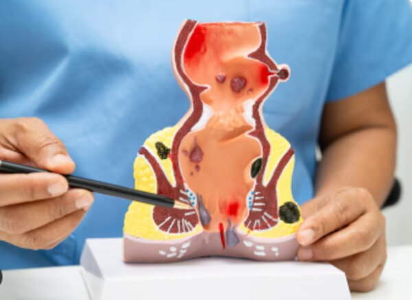 Is Laser Pilonidal Sinus Treatment Suitable for Your Condition in Mumbai