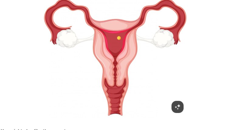 Rectovaginal Fistula Surgery Options for Different Cases in Mumbai