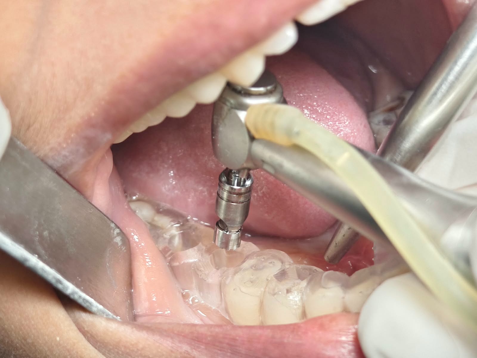 Why Do Dentists Take So Many Measurements Before a Dental Implant?