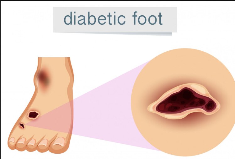 Which Diabetic Foot Surgery Option Fits Your Foot Problem in Mumbai