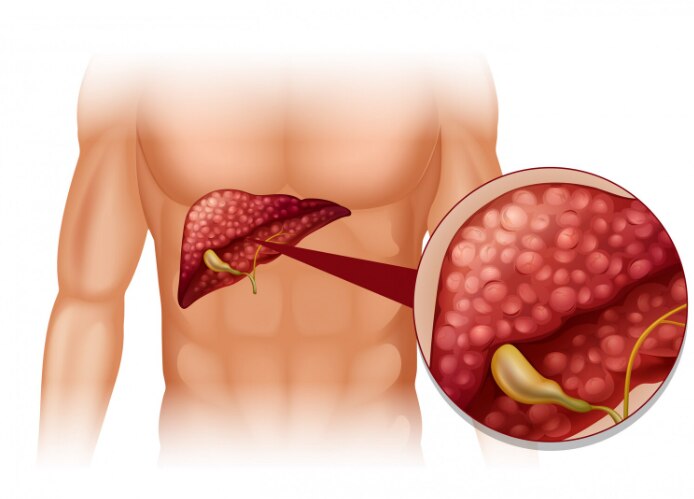 Laparoscopic Gallbladder Surgery Cost near Lower Parel