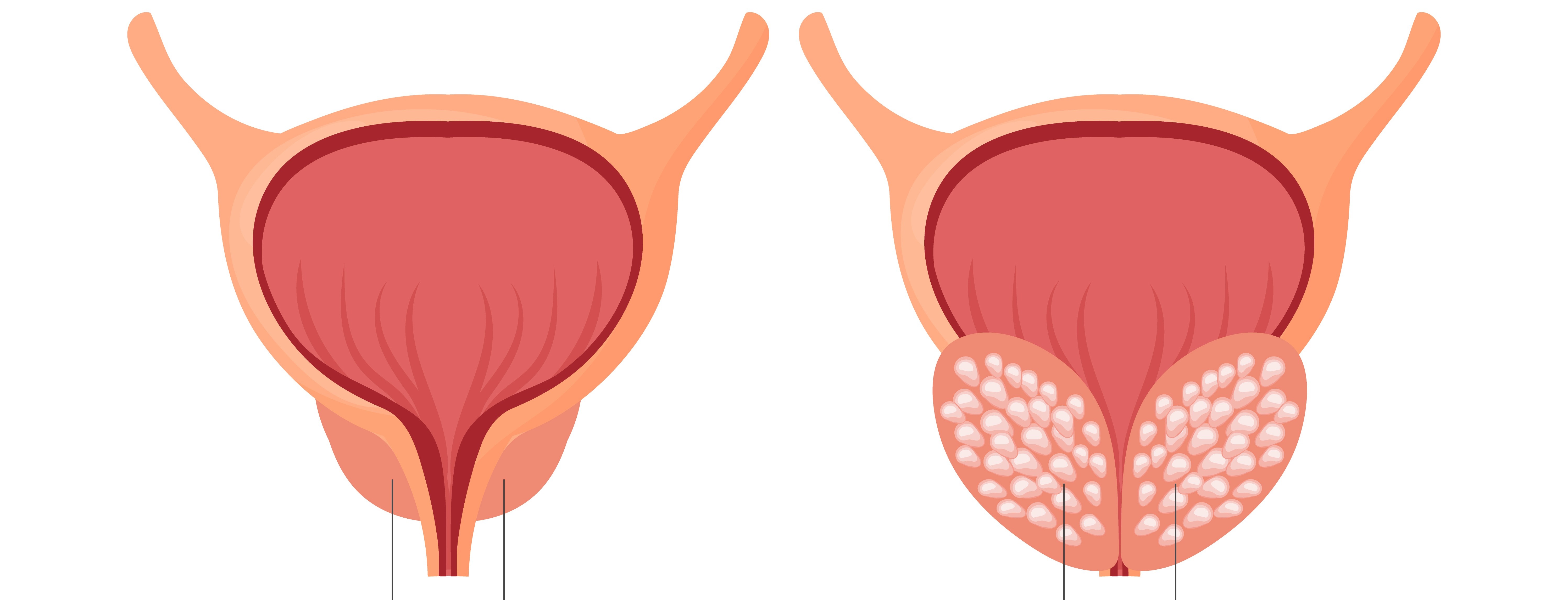 When Benign Prostatic Hypertrophy Needs Specialist Treatment