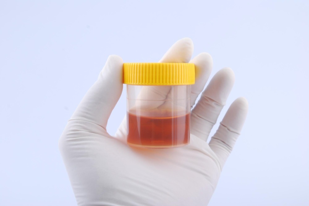 What to Do When Blood in Urine Appears Without an Obvious Cause