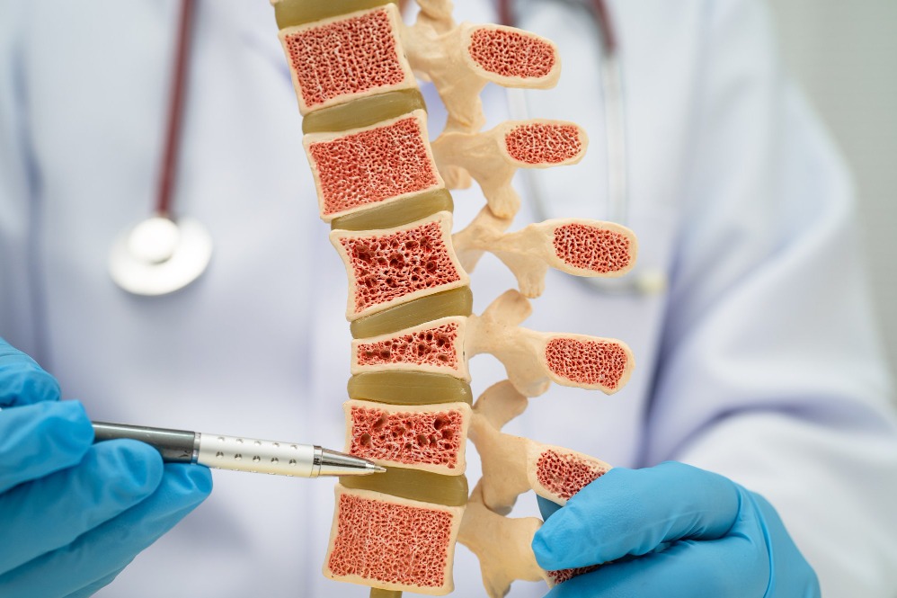 Osteoporosis Treatment in Prabhadevi: How to Protect Bone Health and Reduce Fracture Risk