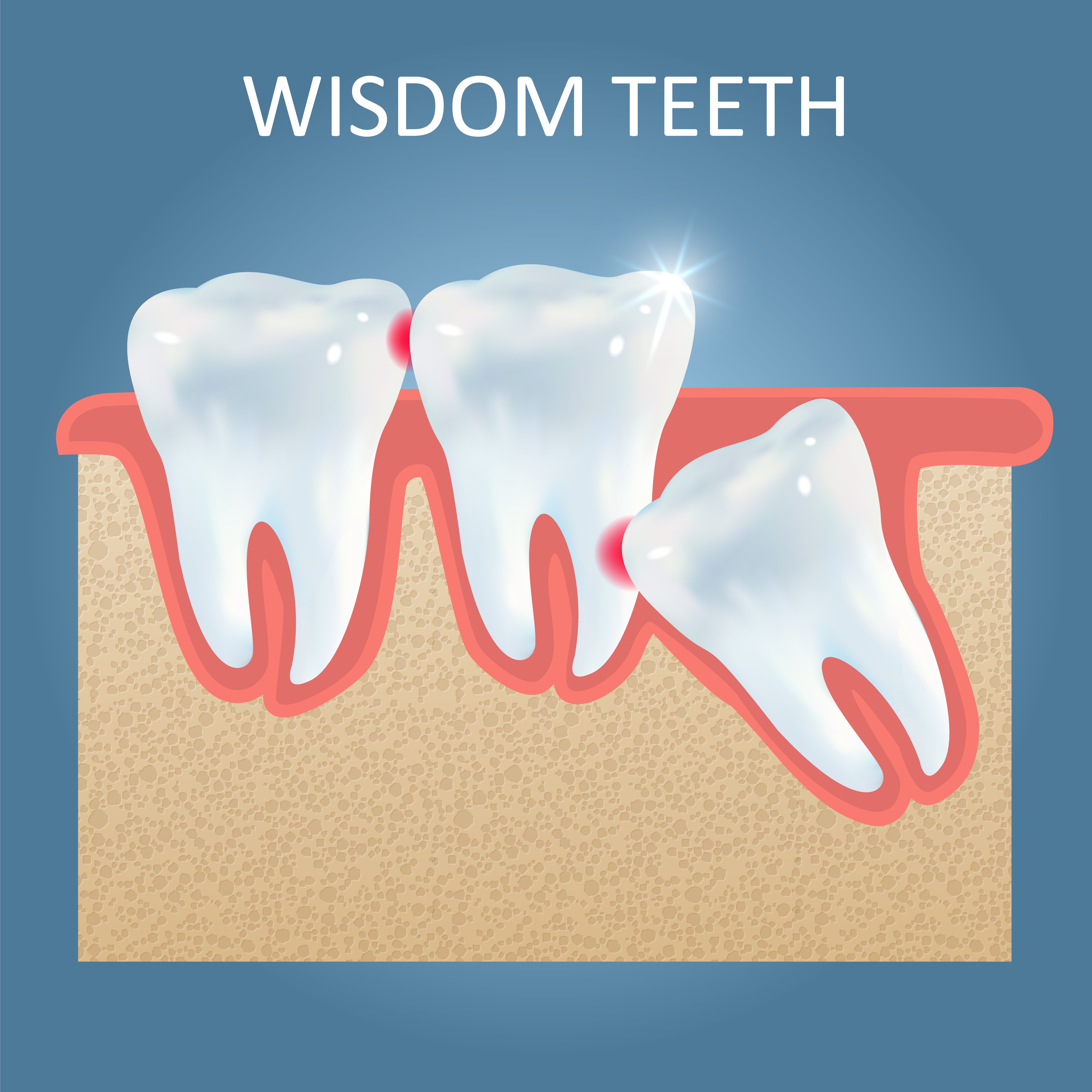 What to Expect During Wisdom Tooth Removal From Assessment to Recovery