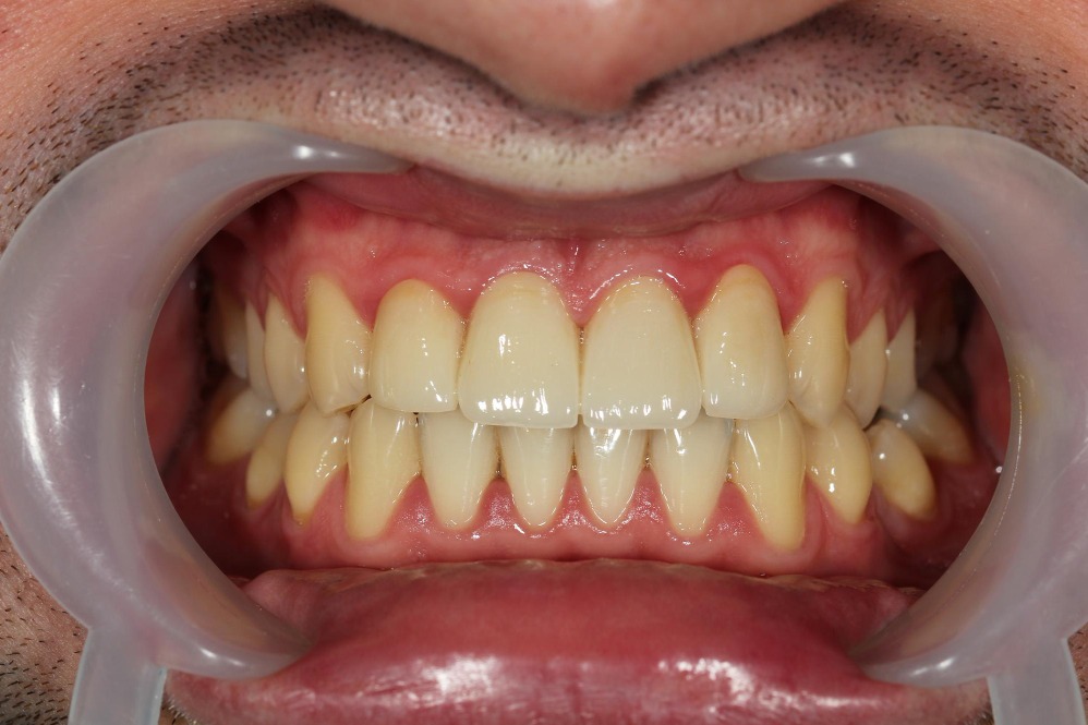 Full Mouth Rehabilitation Treatment