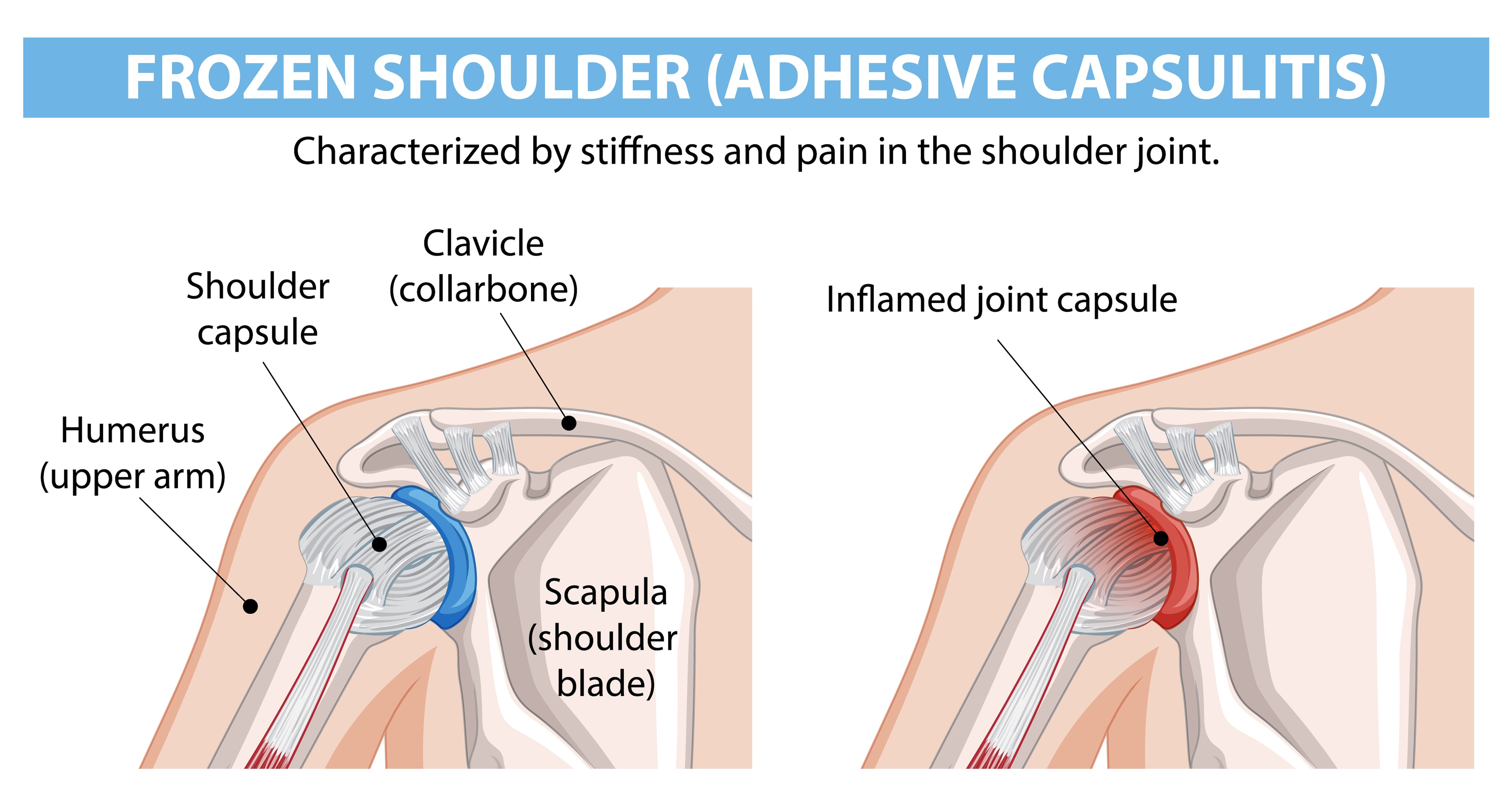 Can Frozen Shoulder Treatment Help Older Adults in Mumbai